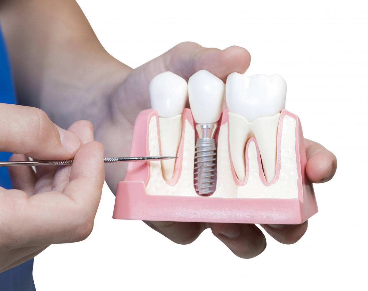 Implantaciya-zubov